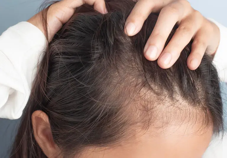 Hair Loss in Women: Causes, Treatments & How We Can Help