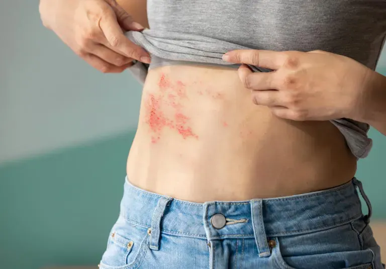 Shingles Survival Guide: Spot It, Treat It, Prevent It